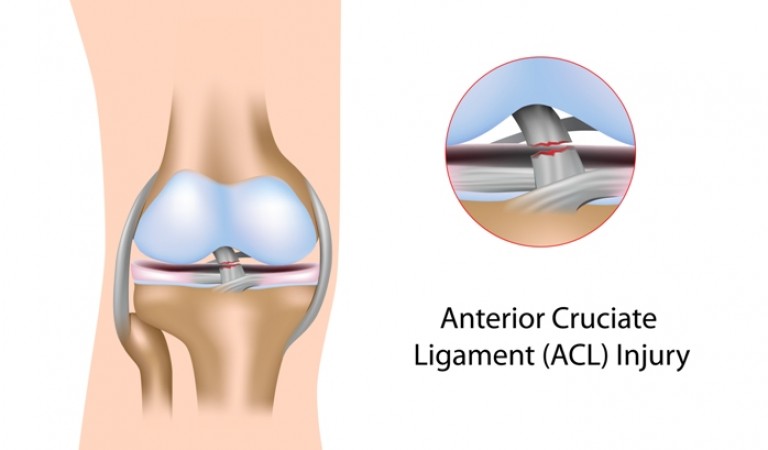 ACL injuries